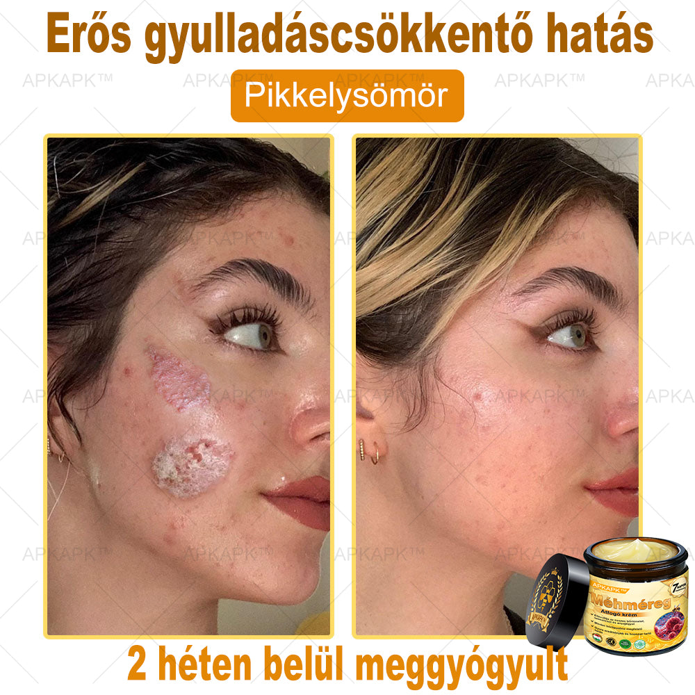 ΑΚΑPK®Méhméreg Átfogó Krém 🧑‍⚕️🧑‍⚕️ 🥇 Segít a bőrproblémák kezelésében, mint például: ráncok, hegek, pigmentációs foltok, striák, pattanások, pikkelysömör, ekcéma, bőrelváltozások, irritációk, gyulladások és egyéb bőrproblémák 🔥