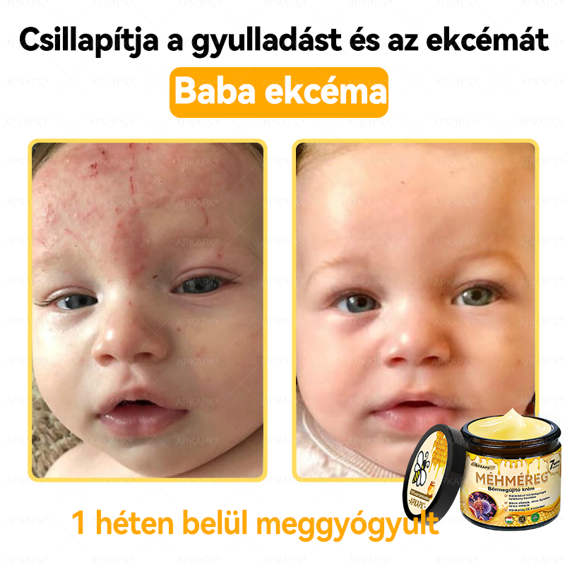 ✨💜💜APKAPK® 𝐌É𝐇𝐌É𝐑𝐄𝐆 Á𝐓𝐅𝐎𝐆Ó 𝐊𝐑É𝐌🥇𝐀 bőrnövedékek 𝐤𝐞𝐳𝐞𝐥é𝐬𝐞 𝐦𝐚𝐠á𝐛𝐚𝐧 𝐟𝐨𝐠𝐥𝐚𝐥𝐣𝐚: é𝐥𝐞𝐭𝐤𝐨𝐫𝐢 𝐟𝐨𝐥𝐭𝐨𝐤, 𝐡𝐞𝐠𝐞𝐤, 𝐬𝐳𝐞𝐦ö𝐥𝐜𝐬ö𝐤, 𝐛ö𝐫𝐧ö𝐯𝐞𝐝é𝐤𝐞𝐤, 𝐭á𝐥𝐲𝐨𝐠𝐨𝐤, 𝐩𝐚𝐭𝐭𝐚𝐧á𝐬𝐨𝐤, 𝐞𝐤𝐜é𝐦𝐚, 𝐩𝐬𝐨𝐫𝐢𝐚𝐬𝐢𝐬, 𝐚𝐜𝐧𝐞 𝐢𝐧𝐯𝐞𝐫𝐬𝐚, 𝐫á𝐧𝐜𝐨𝐤, 𝐛ö𝐫ö𝐫𝐞𝐠𝐞𝐝é𝐬 é𝐬 𝐞𝐠𝐲é𝐛 𝐩𝐫𝐨𝐛𝐥é𝐦á𝐤🔥💜